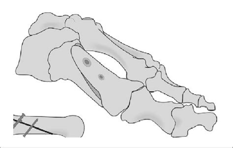 A Sketch Of The Ludloff Osteotomy For Hallux Valgus Treatment