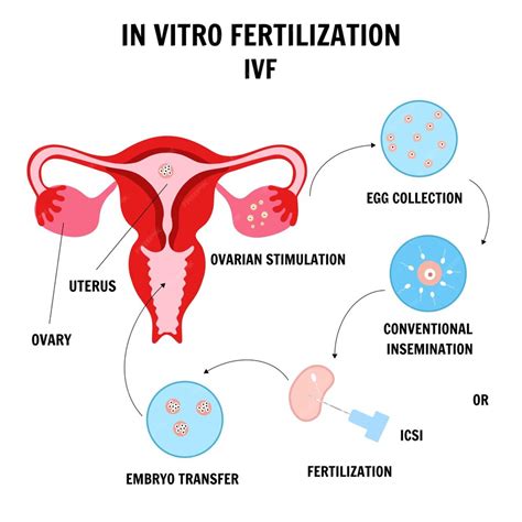 Premium Vector In Vitro Fertilization Concept With Sperm Preparation