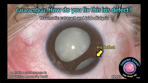 CataractCoach™ 2073: Quiz: How do you fix this iris defect ...