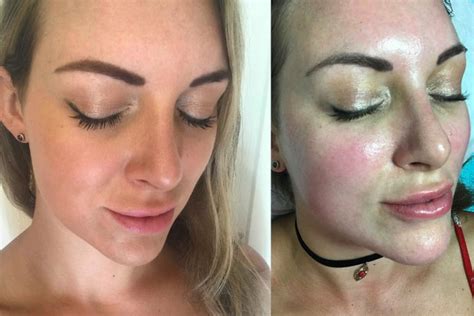 Caci Synergy Facial Toning Treatment Tracy Kiss