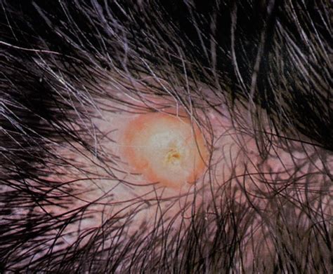 Pilar Cysts Causes Picture Symptoms And Treatment