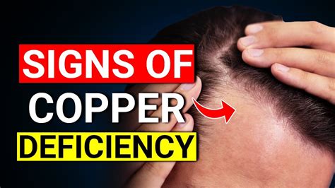 You Have To Know These Hidden Signs Of Copper Deficiency Youtube