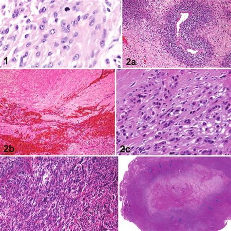 Main types of necrosis in smooth muscle tumors. a, Tumor cell necrosis ...