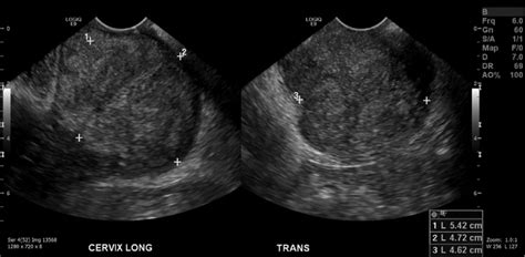 Uterine Cancer Ultrasound Images