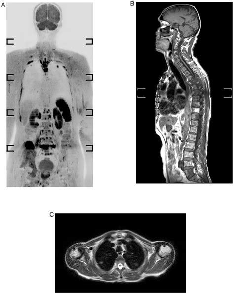 Whole Body Mri Of A 69 Year Old Male Who Developed Prostate Cancer