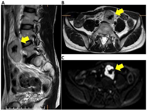 Surgical Resection For Pelvic Retroperitoneal Castleman S Disease A