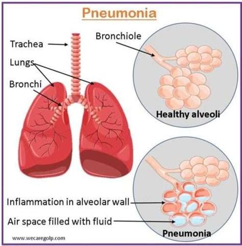 Pneumonia Causes Symptoms Management We Care