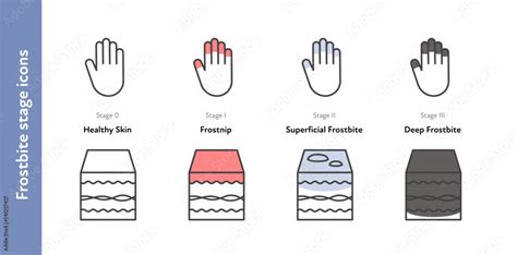 Frostbite anatomical icon set. Vector flat healthcare illustration ...