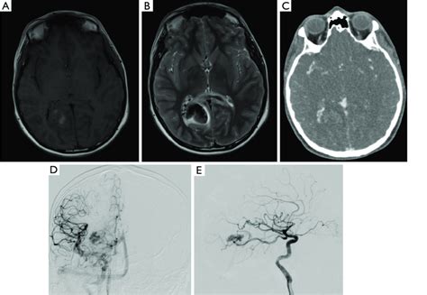 Haemorrhagic Stroke With An Avm A 15 Year Old Male Presented With Download Scientific Diagram