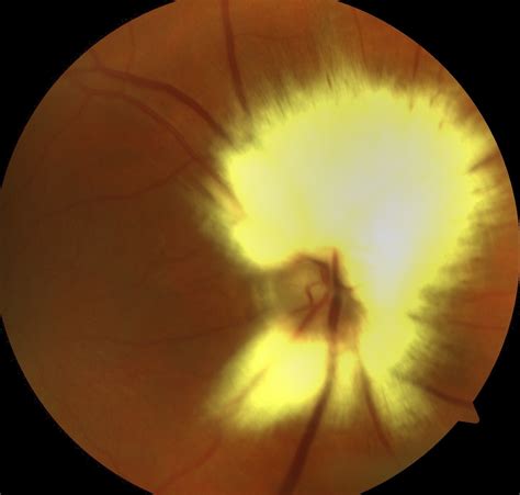 Persistent Myelinated Nerve Fibers The Retina Vault