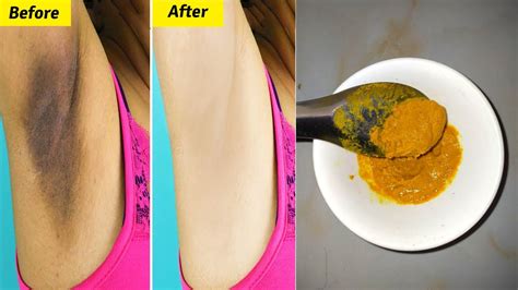 How To Lighten Dark Underarms Fast Naturally At Home Whiten Dark