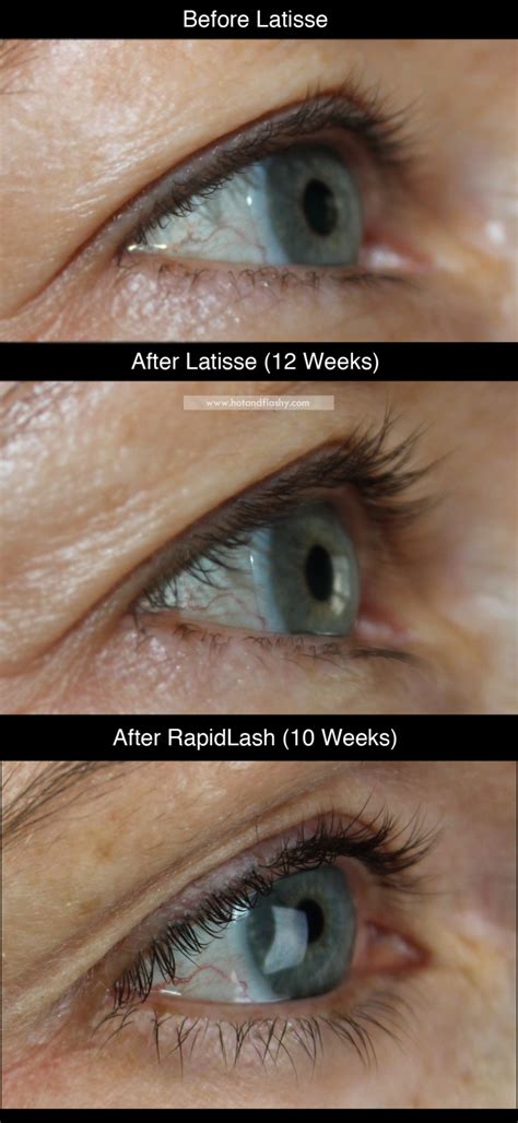 Rapidlash Review Latisse Comparison