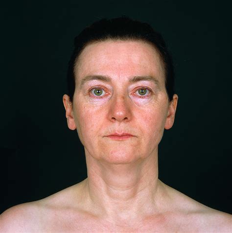 Cosmetic Eyelid Surgery Patient Photograph By Alex Bartel Science Photo