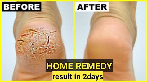 Crack Heels Home Remedy In Days Crack Heels Reduce Completely By Low