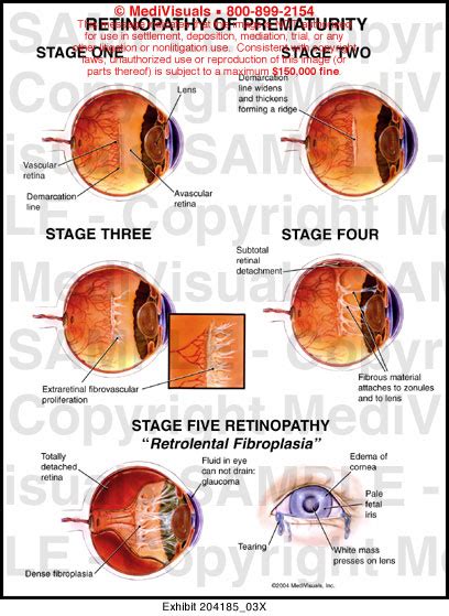 Medivisuals Retinopathy Of Prematurity Medical Illustration