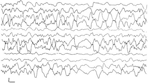 A Eeg Recording Showing Widespread Slow Wave Activity In Association