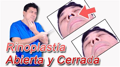 4 Diferencias Entre La Rinoplastía Abierta Y La Cerrada Youtube