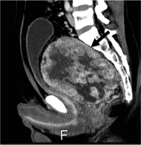 Surgical Resection Using Retroperitoneal Approach For Solitary Fibrous