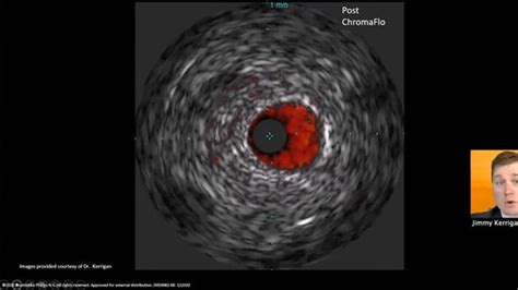 Coronary Ivus Intravascular Ultrasound Philips