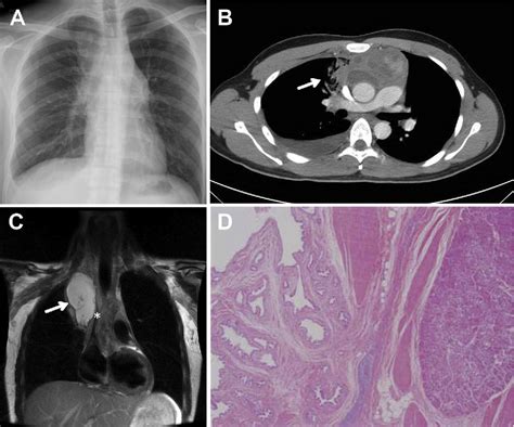 Figure 1 From Spontaneous Rupture Of A Cystic Mediastinal Teratoma