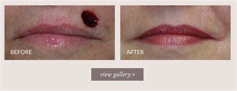 Before And After Mohs Surgery Upper Lip