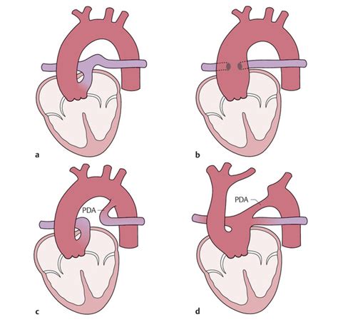 15 Congenital Heart Defects Thoracic Key