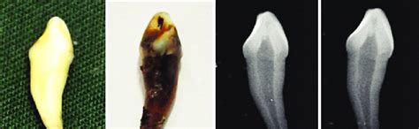 Morphological And Radiographic Changes In Sample Specimen From Group A