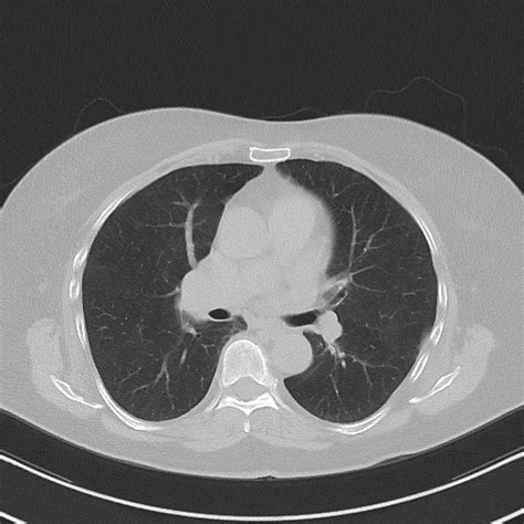 Pulmonary Sequestration Chronic Image Radiopaedia Org