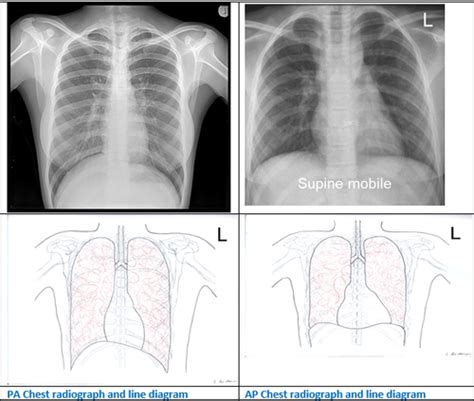 Chest X Ray Interpretation Flashcards Quizlet