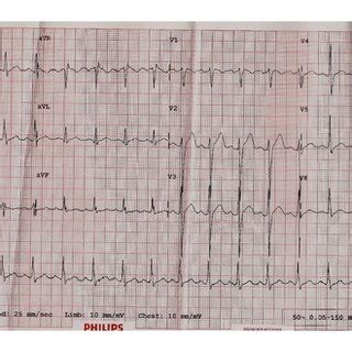 Lead Electrocardiogram Showing Sinus Rhythm With Left Ventricular