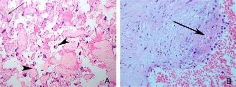 Representative Samples Of Fetal Thrombotic Vasculopathy A