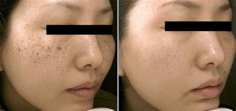 Dark Spot Removal | Dr WW Med Spa & Laser Center