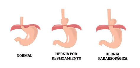 Hernia De Hiato Causas Síntomas Y Tratamientos