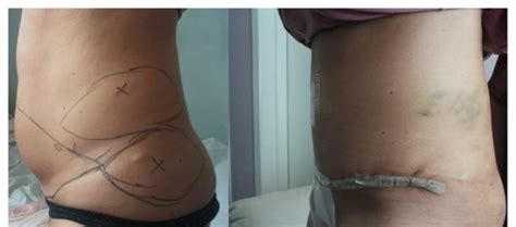 5 Inainte Si Dupa Before And After Abdominoplastie