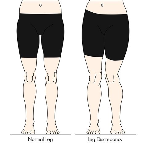 Foot Talk Fridays Leg Length Discrepancy In Children Dubai Podiatry