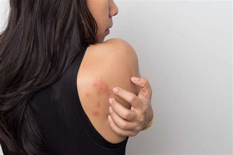 Skin Allergy Symptoms: What You Should Watch For