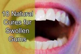 18 Natural Cures for Swollen Gums – Home Remedies