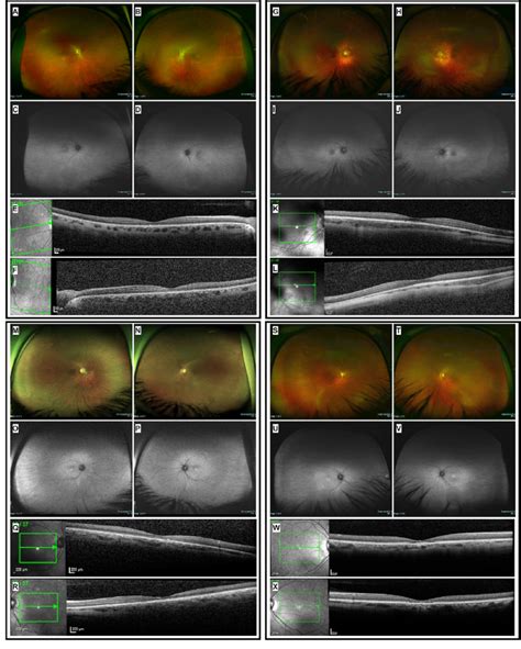 Color Fundus Fundus Autofluorescence Faf And Spectral Domain