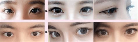 Differences Between Incisional And Non Incisional Double Eyelid Surgery