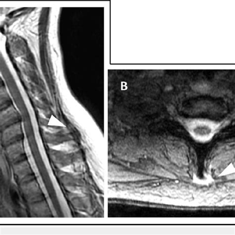 Magnetic Resonance Imaging Mri T Sequence Images Of The Cervical