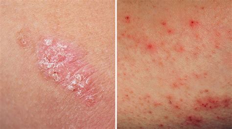 What Is The Differences Between Eczema And Psoriasis Zohal