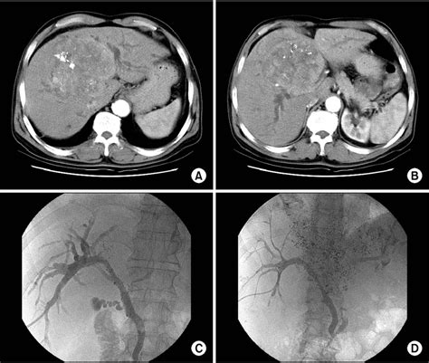 A 68 Year Old Man With Hepatocellular Carcinoma HCC With Previous