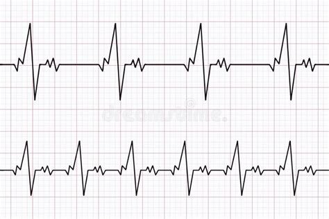 Electrocardiogram Paper With Normal Ecg Stock Vector Illustration Of