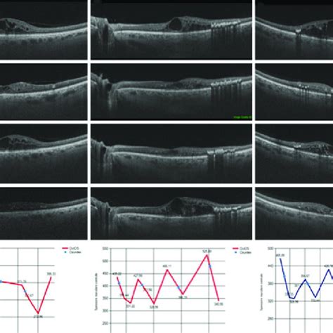 Dilated And Dropout Retinal Capillaries In Peripheral Retinal Visible