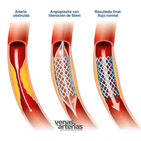 Angioplastia Pierna Con Stent Bal N Dr Sinuh Reyes Oaxaca