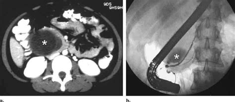 Choledochal Cyst A Ct Scan Demonstrates A Dilated Redundant Common Download Scientific