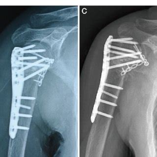 A 43 Year Old Patient With Neer 4 Part Proximal Humeral Fracture