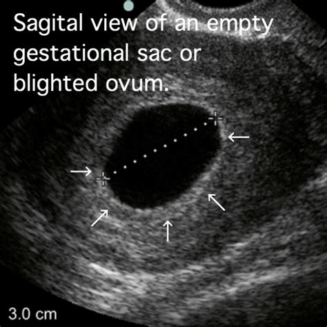 Blighted Ovum Cause Symptoms Ultrasound Treatment Prevention Etc