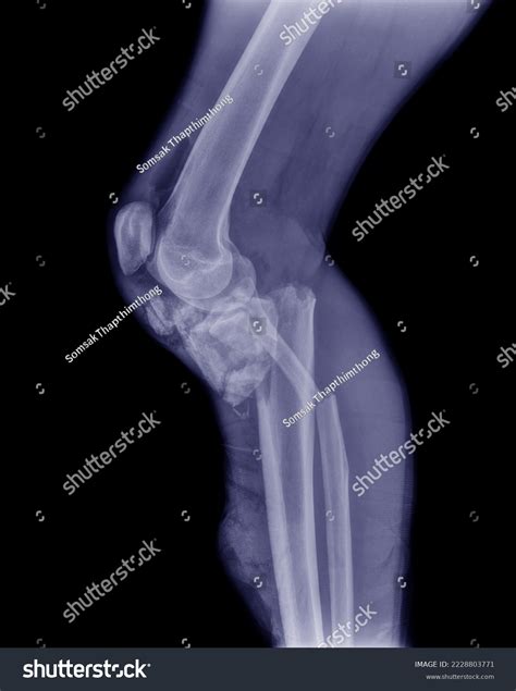 Xray Image Femur Showing Fracture Upper Stock Photo 2228803771 ...