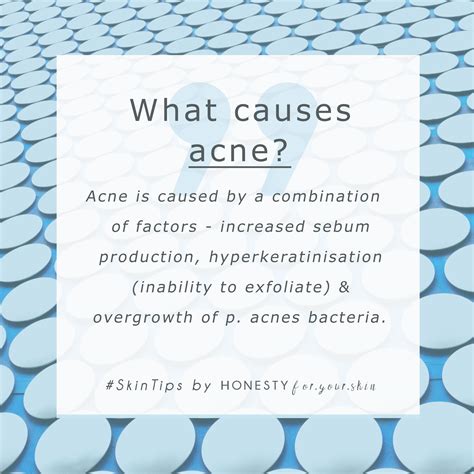 A potential cure for acne… and it s not skincare – Artofit